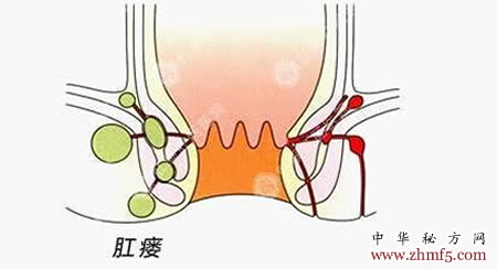 肛瘺的最新治療方法,肛瘺的最新治療方法